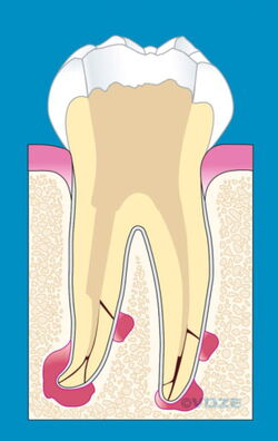 Alte Wurzelfüllung entfernt