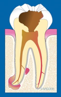 Der erkrankte Zahn