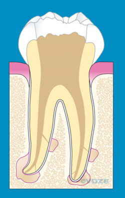 Der gesäuberte Zahn