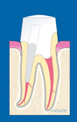 Zahn mit Stift vor Überkronung