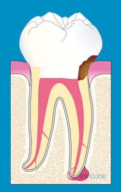 Karies bis zur Wurzelfüllung