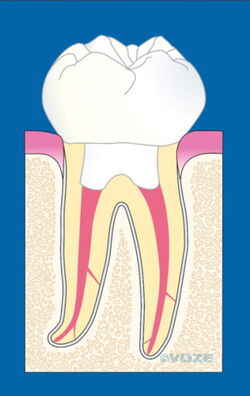 Der geheilte und überkronte Zahn